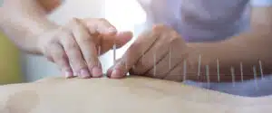 טיפול בדיקור סיני - כאבים, מחטים ומה שביניהם